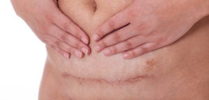 Surgeons often cut on the same scar when performing C-sections and hysterectomies, leading to adhesions that can make surgery more technically difficult.